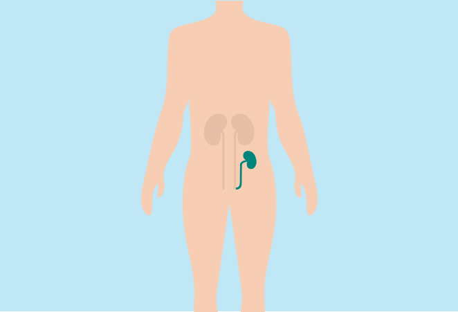 Illustration of a kidney transplant